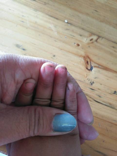 帮我一起育儿_宝宝腹泻大便绿色有冻冻,指甲没