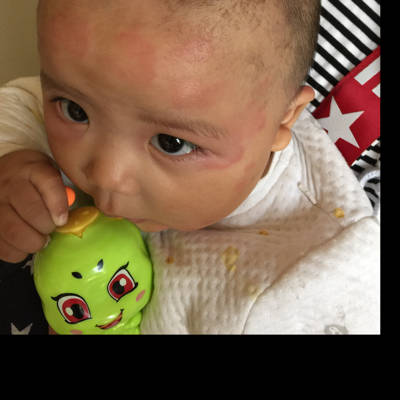 宝宝发烧了 脸上身上也起疙瘩了 这是过敏还是