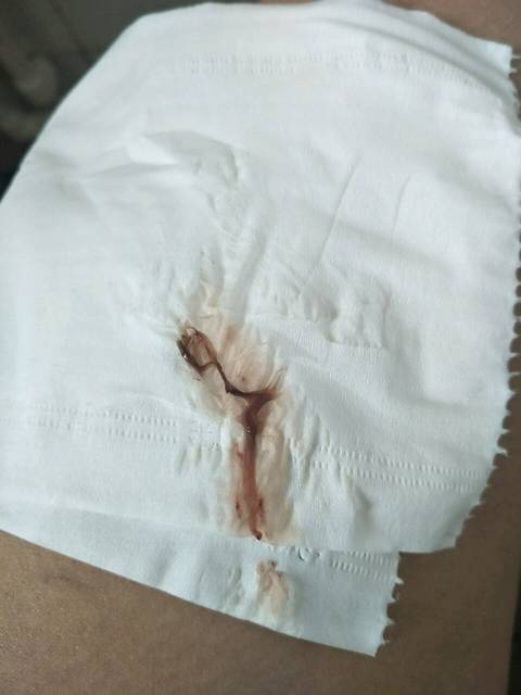 末次月经4.1日,最近有深咖啡色分泌物,不多_我