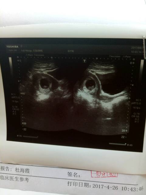 我是试管,孕酮很低