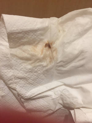 白带发灰,怎么回事? 孕三四周左右开始肚子疼