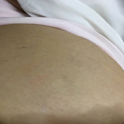 孕26周,发现肚子上有青筋,不疼不痒的,请问这是不是要