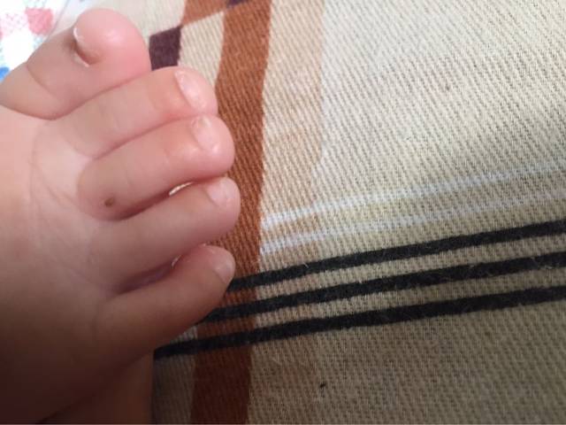 脚上长黑点点了_无意中看到宝贝脚上长的黑点