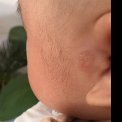 宝妈们,三个月宝宝耳朵边长这个是藓吗?要用什么药吗