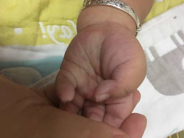 急!宝宝手掌两侧与指尖发红