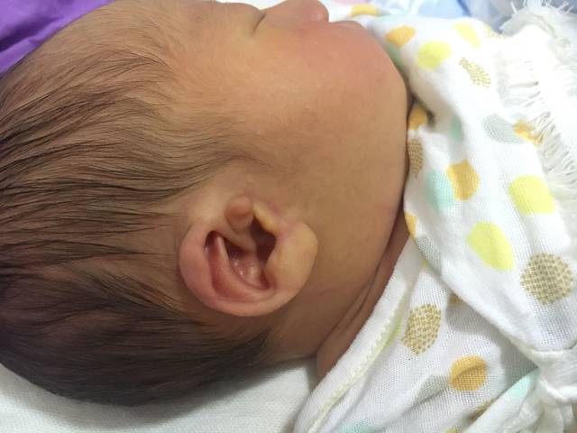 新生儿宝宝耳朵一大一小,怎么办?可以矫正吗