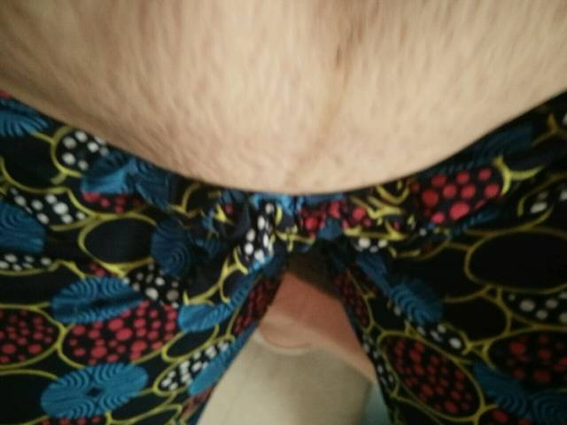 产后妊辰纹肚子 好可怕