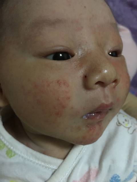 有没有和我儿子一样的有婴儿痤疮的_7.4号出生