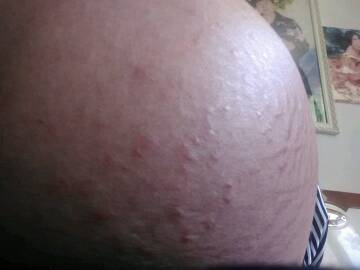37周妊娠纹有红疙瘩痒死了腿上也起了疙瘩痒死了怎麼办