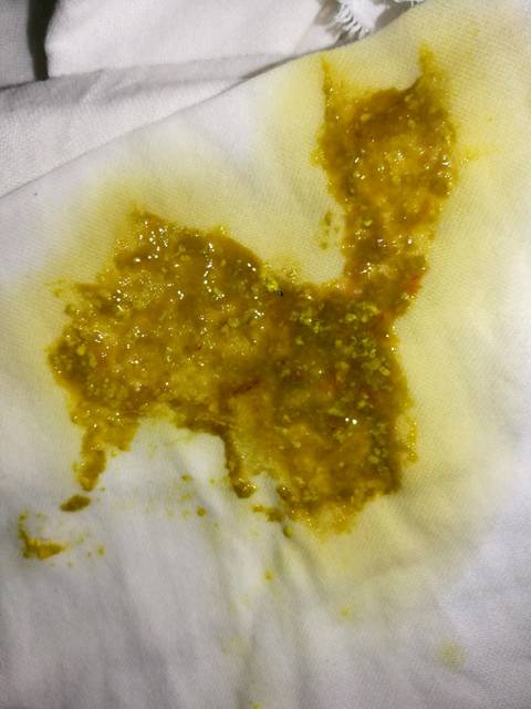 ,大便带血丝,有见过怎么回事的吗