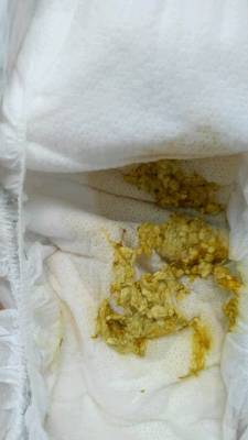 四个半月男宝宝腹泻21天了,没病毒细菌感染,但就是大便性状,次数不