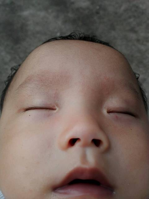 宝宝脸上长了很多小米粒一样的小疙瘩