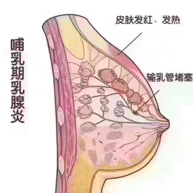 乳腺炎的演变