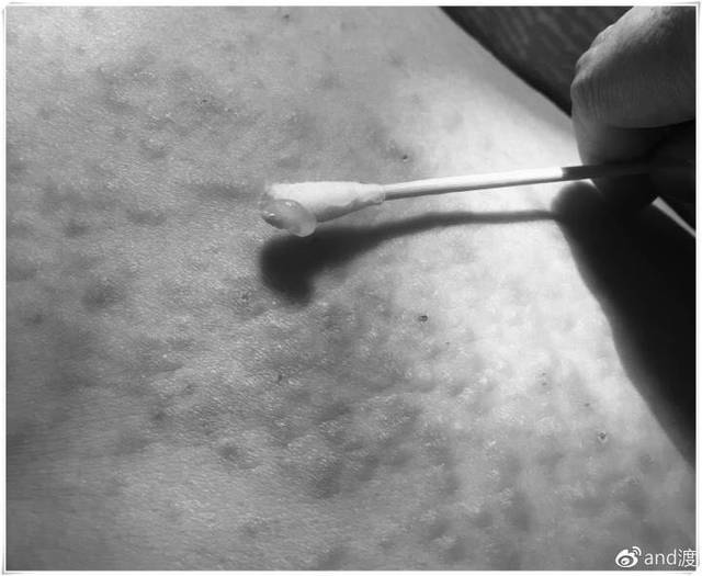 别样孕照--孕疹妈妈(湿疹痒疹,真的能玩死孕妈