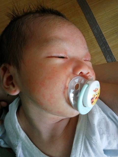 婴儿痤疮_有没有宝妈知道的 宝宝前几天脸上就