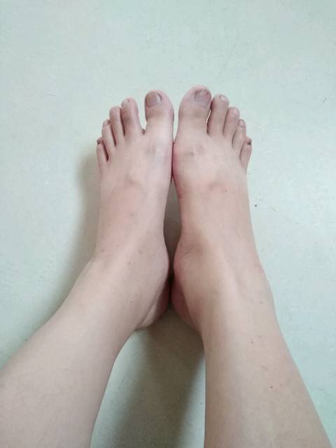 39+4还没动静,脚水肿严重_最近一个月手脚都