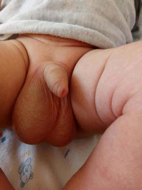 这是怎么了吗_满月孩子的睾丸一边大一边小还