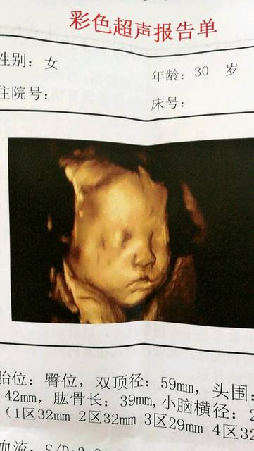 四维归来,双肾集合系统分离_24周四维,宝宝很