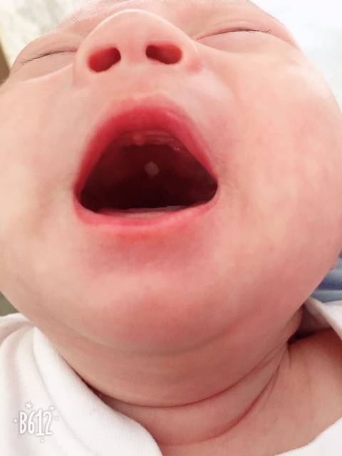 求助!2个月宝宝上颚长类似白色脓包怎么回事?
