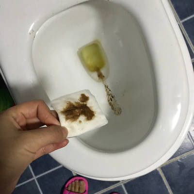 孕40天,孕酮69nmol\/L hcg22000.今天流褐色第