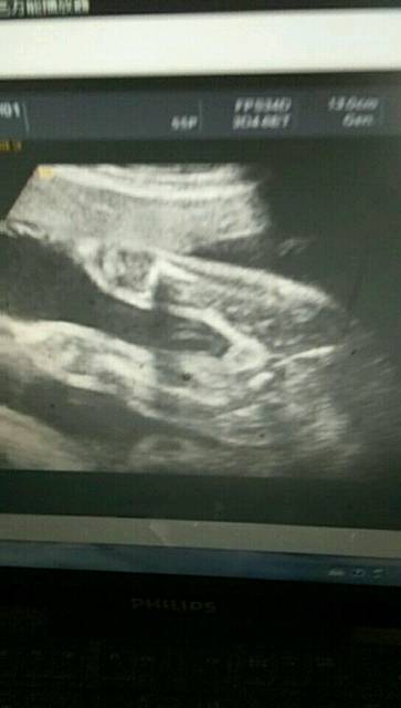 b超显示胎儿两腿中间有小白点,会是女孩还是男孩?