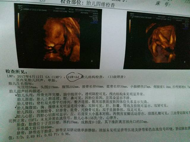 四维,双肾无分离,是女孩吗?