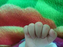 宝宝手上出现了一些小水泡,中指食指关节都有