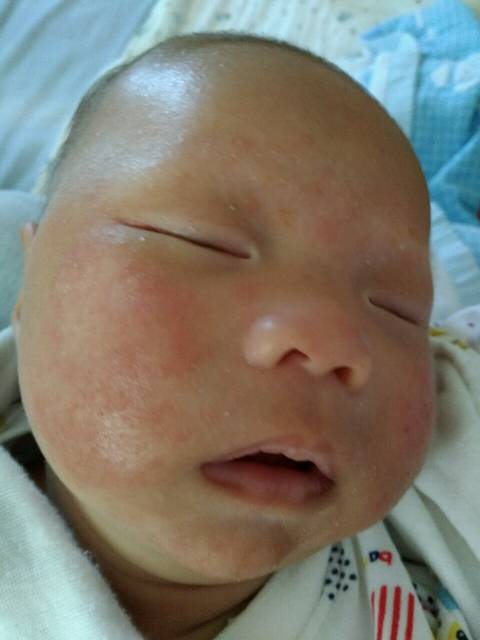 两个月宝宝脸上长奶藓,湿疹怎么办?