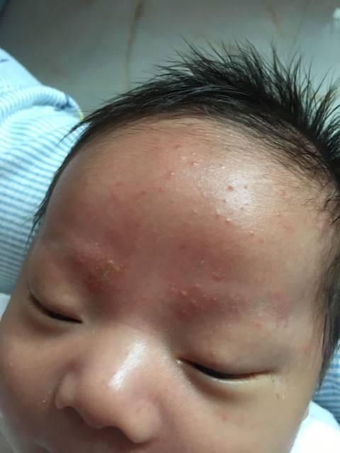 湿疹是什么样的_不知道宝宝这是热毒还是湿疹