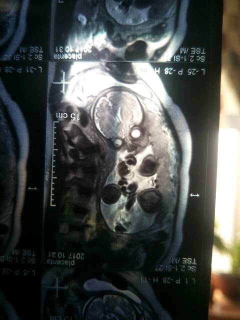 孕32周做的磁共振,看看是不是明显的女宝宝呀