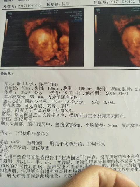 孕5月,因为股骨短,我要和宝宝说再见了吗_我不