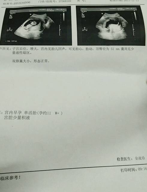 11周建卡时尿检三个+是什么意思啊?对宝宝发