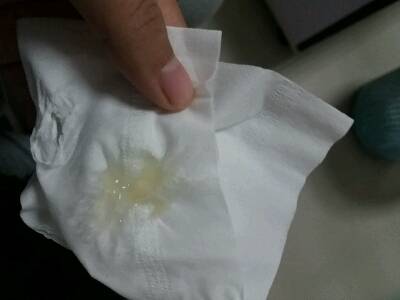 连续四天每天都会出一坨这个东西,感觉不是白带吧,比白带粘稠多了.