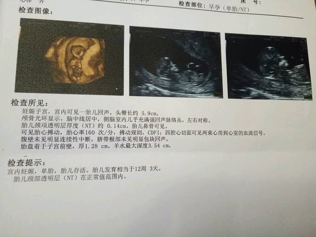 有哪位亲懂看男女的,附上nt彩超报告