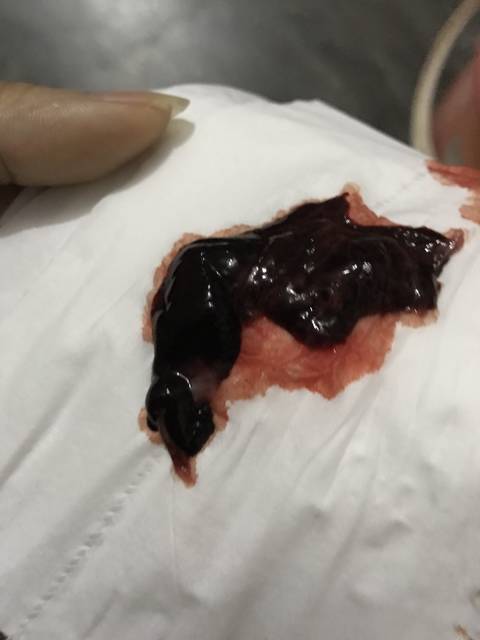 是生化还是自然流产_这次备孕一年停经46天,才