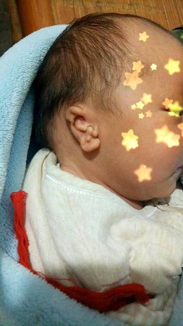 宝宝耳朵畸形,有知道现在需要注意什么的吗?