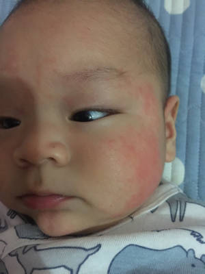 三个月宝宝,脸上头上红点点一片一片的,有时候