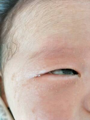 宝宝两个月了,眼睛有多多眼屎黄浓色,眼睛有血