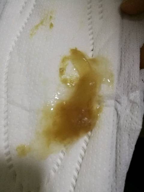 有图!慎进!宫颈粘液栓