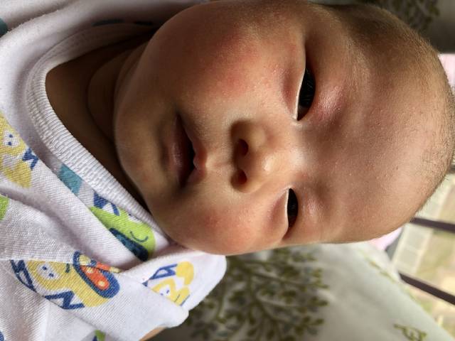 过敏跟湿疹有什么区别?