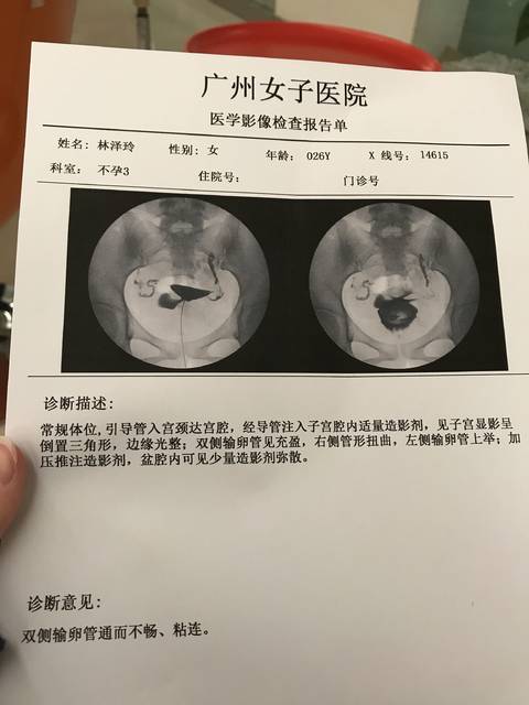 盆腔粘连,盆腔炎一定得治好再怀孕吗?