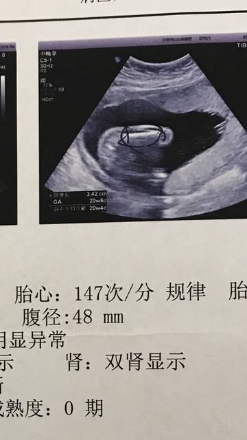 20周大排畸归来,附b超图_这个图是胎儿股骨长,截图两