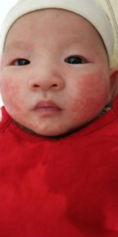 宝宝脸上长红点,摸起来硬硬的是什么呢?