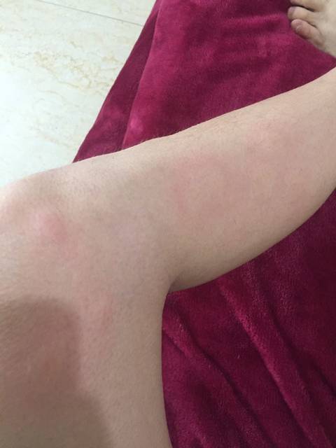 严重过敏,可以擦什么药吗