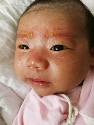 宝宝刚满月最近脸上脖子上起了好多类似湿疹的