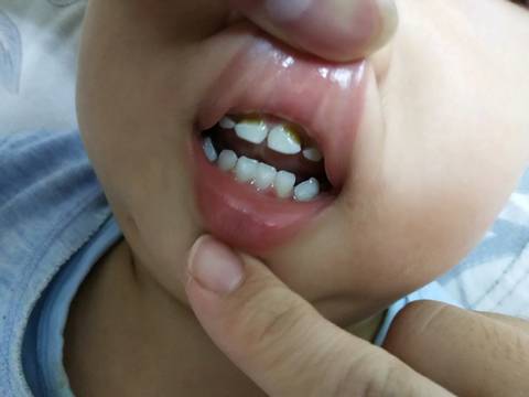 我家宝贝一岁半了,上面四颗牙齿被腐蚀了,有哪位宝妈告诉我该怎么办?