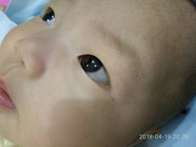 宝宝今天眼睛突然红了什么原因有图