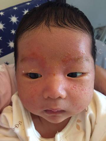 宝宝出生26天,脸上长湿疹了,医生给开了复方黄