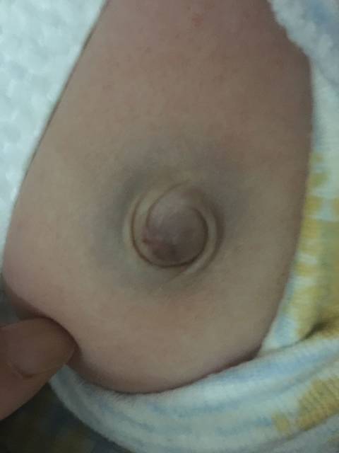 宝宝两个月了肚脐突出怎么办?有图