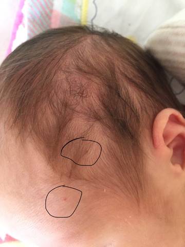 宝宝9天的时候发现头皮上有2个红点,这几天陆